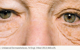Nahaufnahme der Augenpartie eines Lkw-Fahrers mit einseitiger Hautalterung durch jahrelange UV-Strahlung, NEJM 2012